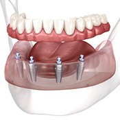 Illustration showing 4 implants in lower arch to support dentures