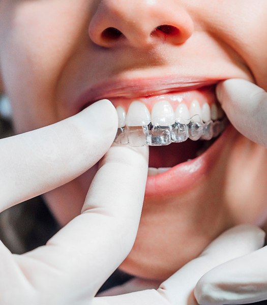 Dentist with white gloves placing clear aligner on patient's top teeth