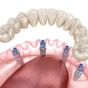 Animated smile dental implant supported denture