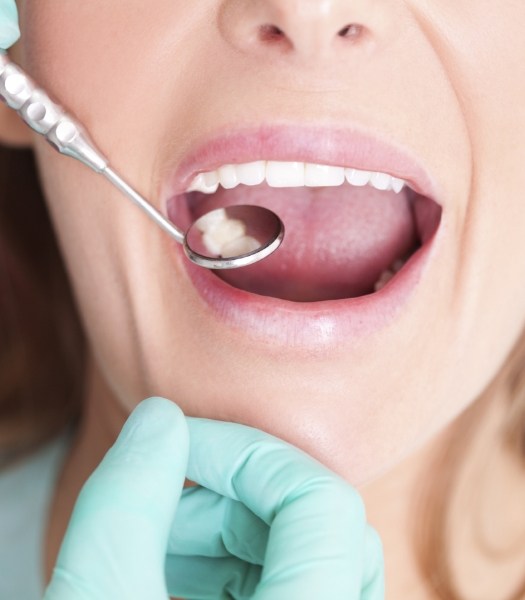 Dentist examining smile after tooth colored filling restorative dentistry treatment