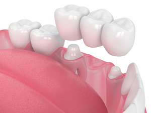 Illustration of dental bridge being placed on teeth