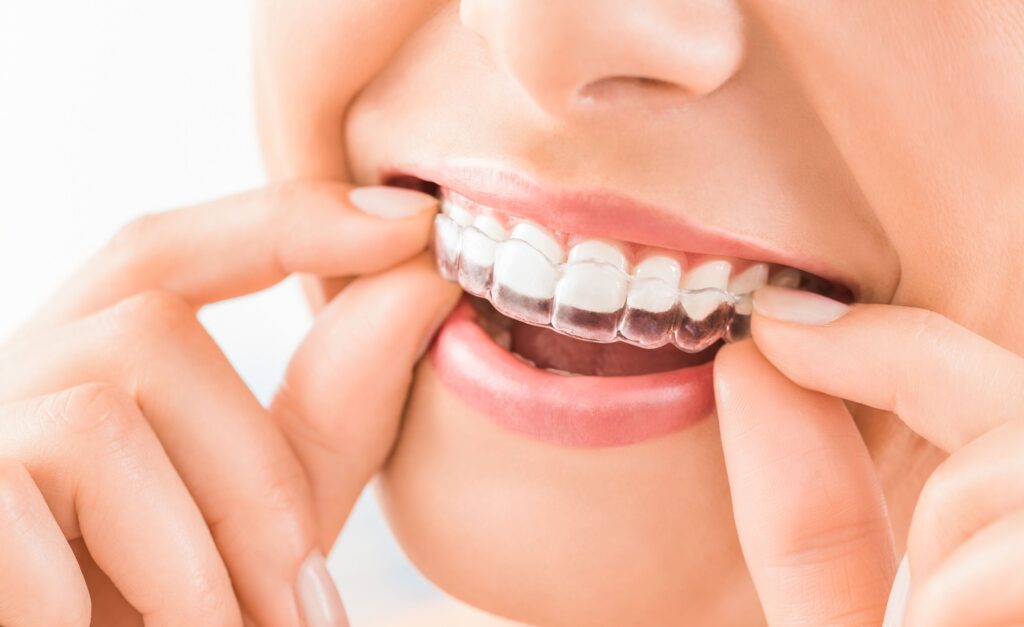 Nose-to-chin view of woman placing clear aligners over top teeth